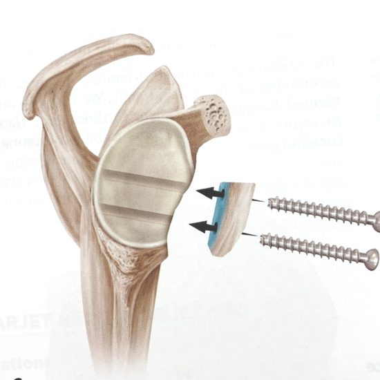 Latarjet and Failed Shoulder Instability Repair | Shoulder Injuries ...