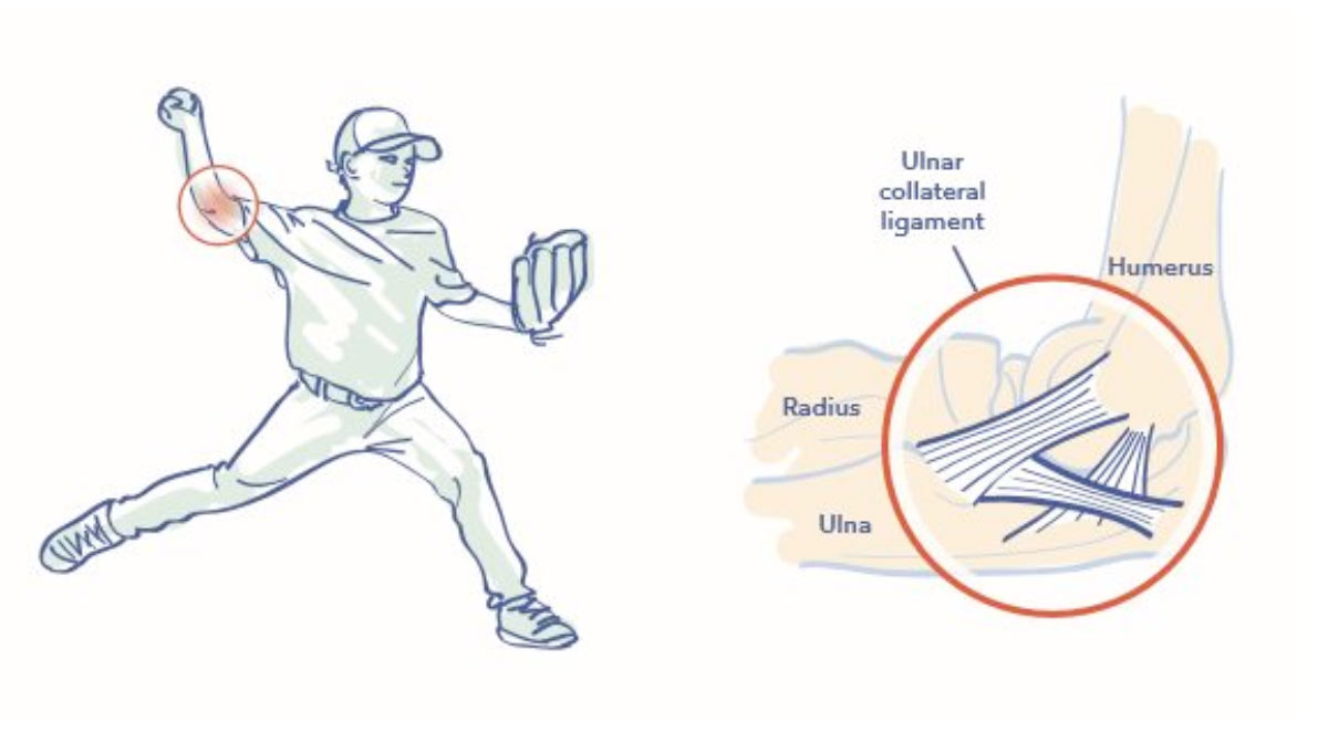 Ulnar Collateral Ligament Tommy John